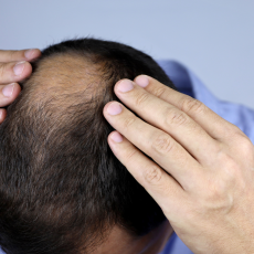 Hair Loss